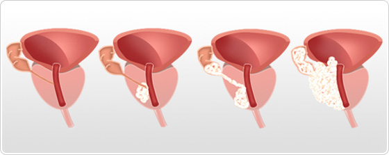 cancer de prostata tipos)